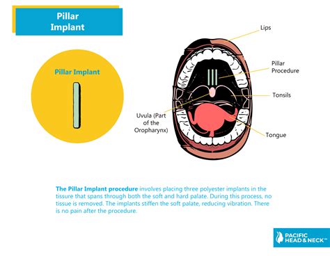 Pillar Implants Snoring And Sleep Apnea Pacific Head And Neck