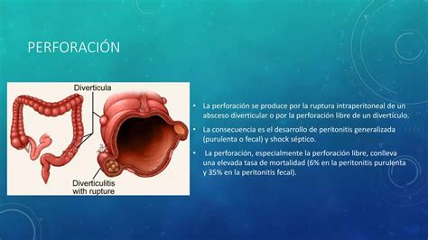 Enfermedad Diverticular De Colon Ppt