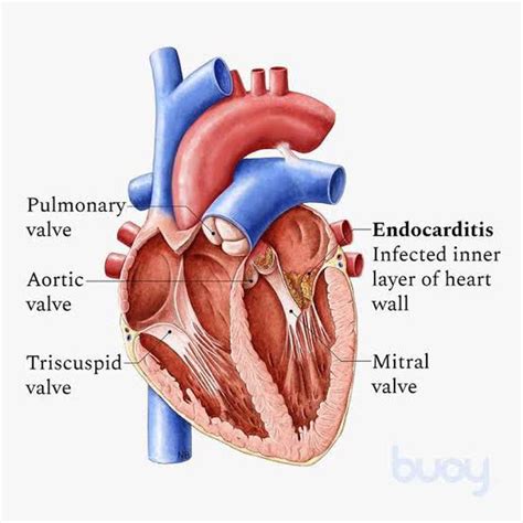 Endocarditis Medizzy