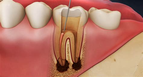 Kanal Tedavisi Endodonti Dent Pozitif A Z Ve Di Sa L Poliklini I