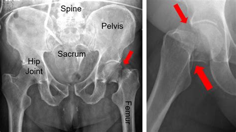 Femoral Neck Fracture