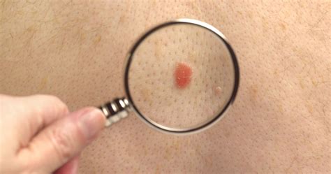 Nodular Melanoma Signs Symptoms And Complications