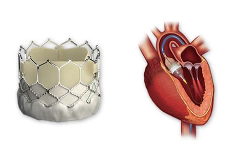 Aortic Stenosis Emory Reaches Treatment Milestone Fda Approval Announced