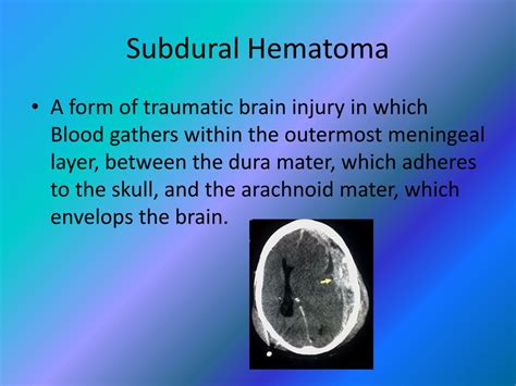 PPT - Epidural/Subdural Hematoma PowerPoint Presentation, free download ...