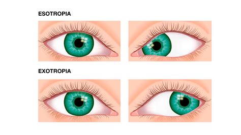 Estrabismo Tudo O Que Você Precisa Saber Sobre A Doença