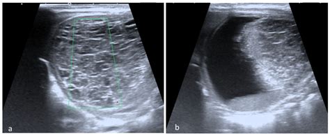 Diagnostics Free Full Text Fetal Ovarian Cysts Prenatal Diagnosis