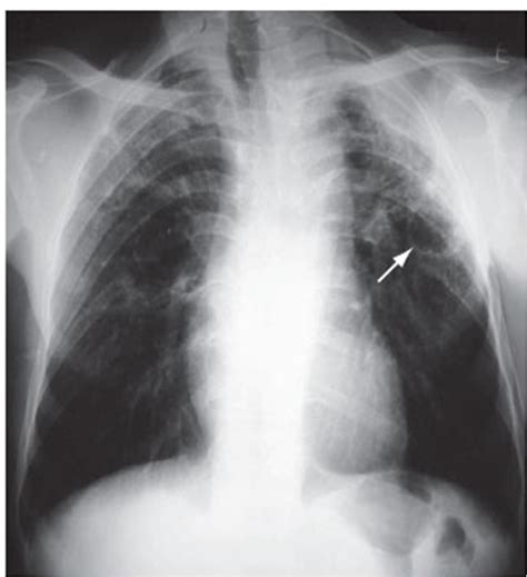 Figure Chest X Ray Of A Patient With Silicosis And Pulmonary