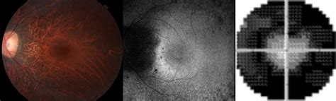 Study Advances Development of Gene Therapy for X-Linked Retinitis ...