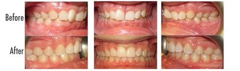 common orthodontic issues duluth cloquet hibbing virginia