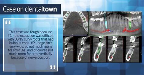 Dentaltown Case Tricky Immediate Implant Bit Ly Qqrlgk