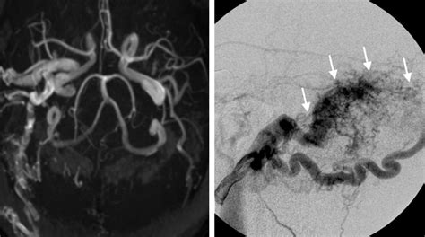 Arteriovenous Fistula Expert Surgeon Aaron Cohen Gadol Md