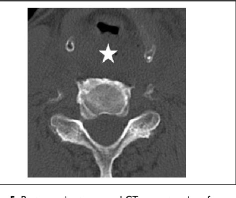 Figure 1 From Surgical Treatment Of Anterior Cervical Osteophytes Causing Dysphagia Semantic