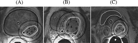 Dosimetric Feasibility Of Ablative Dose Escalated Focal Monotherapy