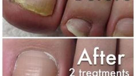 Fungal Nail Infection Removal Rachels Beauty World