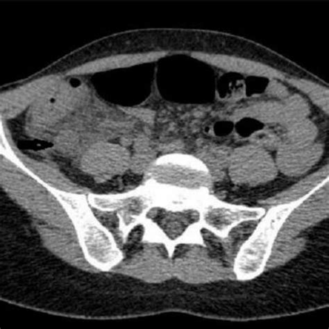 Tdm Abdomino Pelvienne Coupe Axiale Montrant En Un Appendice Paissi
