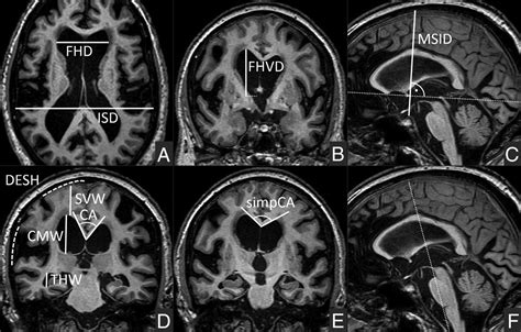 Variability Of Normal Pressure Hydrocephalus Imaging Biomarkers With Respect To Section Plane