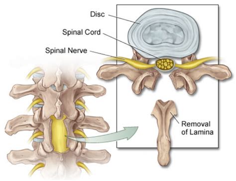 Laminectomy Without Fusion