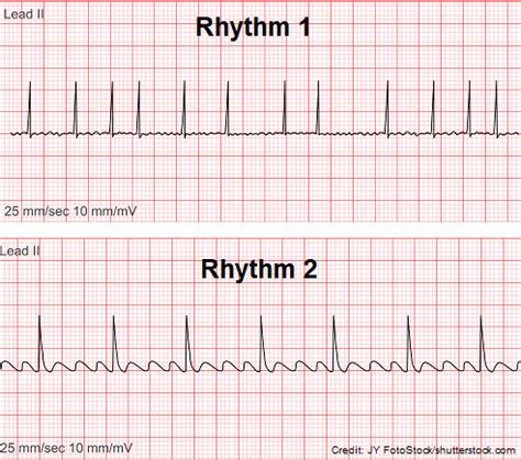 Atrial Flutter A Flutter Quiz Questions ECG EKG