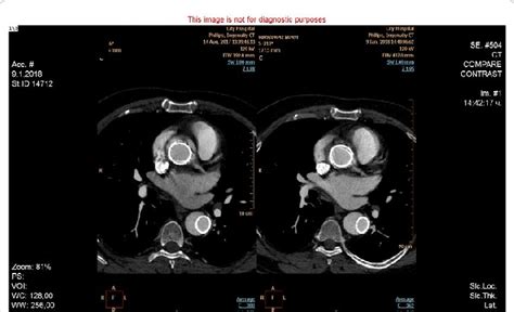 Comparative results from CT aortography performed at 1st and 6th months... | Download Scientific ...