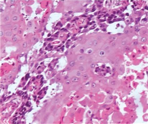 Photomicrographs Of A Breast Metaplastic Carcinoma A Low Download Scientific Diagram