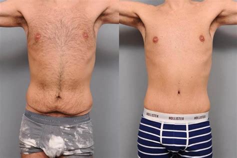 Tummy Tuck Abdominoplasty Operation In T Rkiye