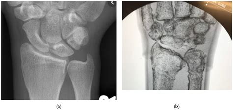 A Human Hand Under Fluoroscopy To Show Hard And Soft Tissue Feedback