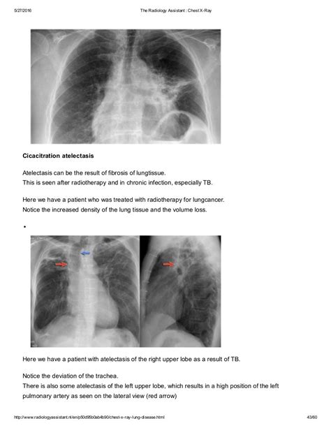 The radiology assistant chest x ray - lung disease