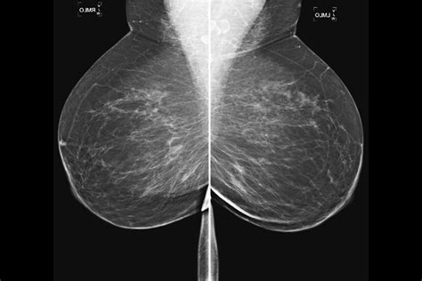 Mammografia Studi Radiologia Gibilisco