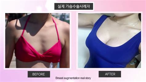 Id Hospital Real Review Breast Augmentation Before And After Youtube