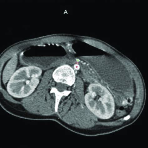 ct scan showing  dilation   stomach   portion   duodenum