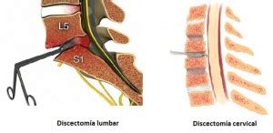 Discopatía Degenerativa Cirugía Neurológica Integral de Oriente