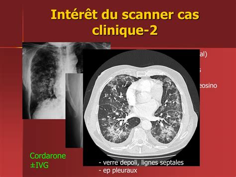 PPT Pneumopathies Communautaires PowerPoint Presentation Free