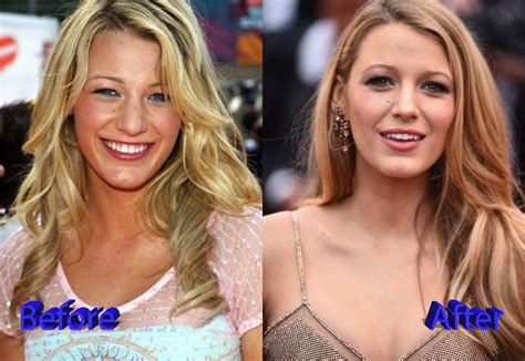 Blake Lively Nose Job: A Slight Change