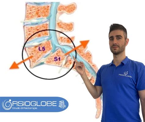 Spondilolistesi Cause Sintomi E Rimedi Fisioglobe