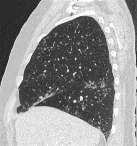 Multinodular Lung Adenocarcinoma Image