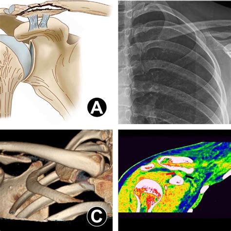 Zanca View Radiograph For Evaluation Of The Injury Pattern Of CC