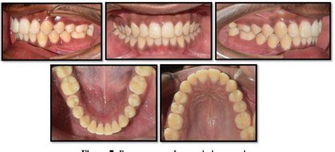 Figure 7 From Class Ii Correction With Forsus Fixed Functional Appliance In Class Ii Division 2