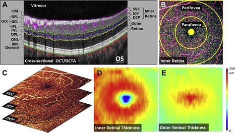 Projection Resolved Optical Coherence Tomographic Angiography Of