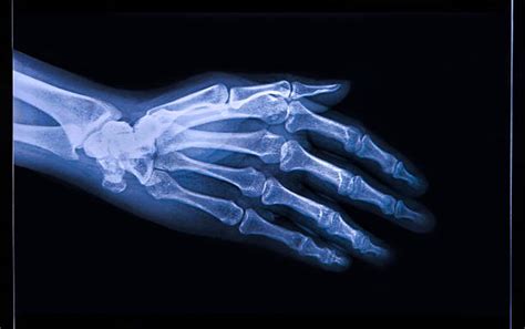 Osteomyelitis X Ray Spine