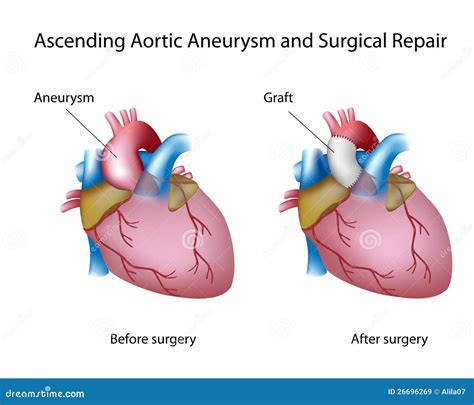 Ascending Aortic Aneurysm Royalty Free Stock Images Image 26696269