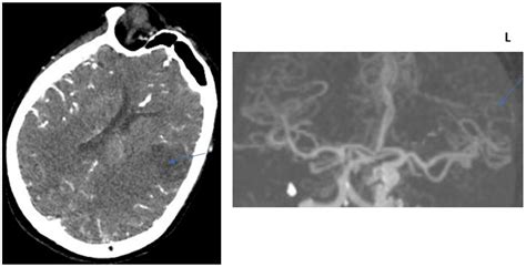 Jcm Free Full Text The Relationship Between Ct Angiography Collateral Score And Biochemical