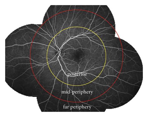 A On A Typical Image The Retina Is Divided Into Three Sections From Download Scientific