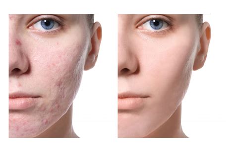 Cicatrici Da Acne Chirurgia Plastica E Medicina Estetica Il Tuo