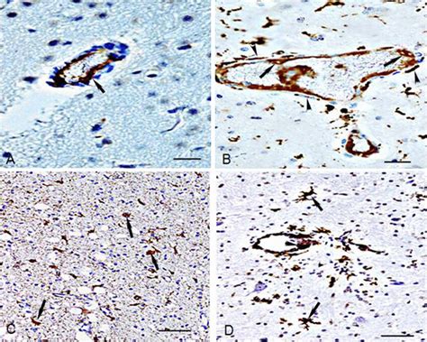 Severe Cdv Infected Endothelia And Astrocytes A Cdv Antigen Intense