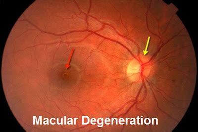 Macular Degeneration Causes, Diagnosis And Treatment | Health And Beauty