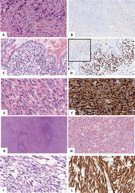 Uterine Sarcomas And Rare Uterine Mesenchymal Tumors With Malignant