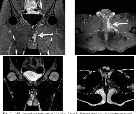 Figure 2 From A Case Of Proximal Type Epithelioid Sarcoma Of The