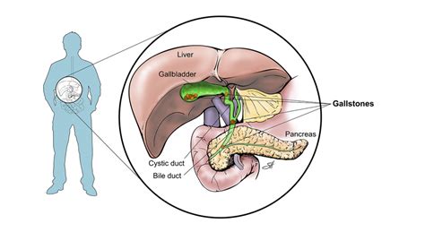 Navigating Gallbladder Removal What You Need To Know