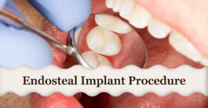 Endosteal Implants: The Key to Restoring Your Smile - Yourfitnessgoal