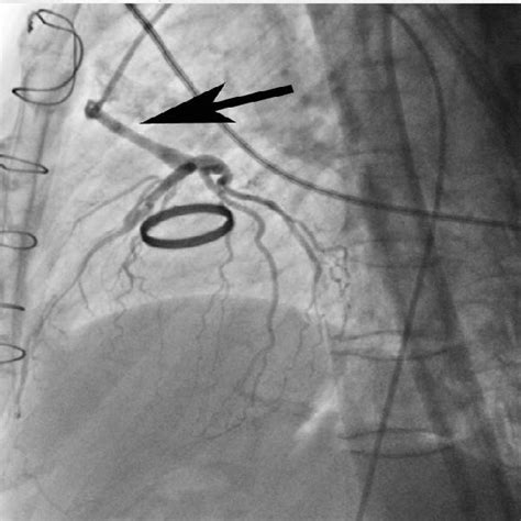 Coronary angiography showing patent saphenous vein graft (arrow)... | Download Scientific Diagram